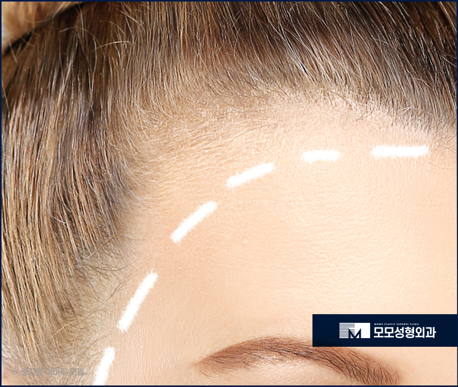 헤어라인 교정 비용 바라던 예후를 만들기 위한 관련 이미지 6