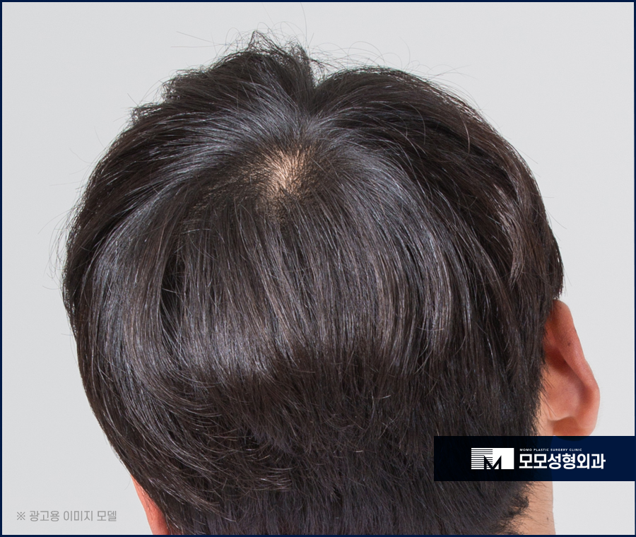 윗머리탈모 촘촘히 채워 고민을 탈출하는 관련 이미지 2