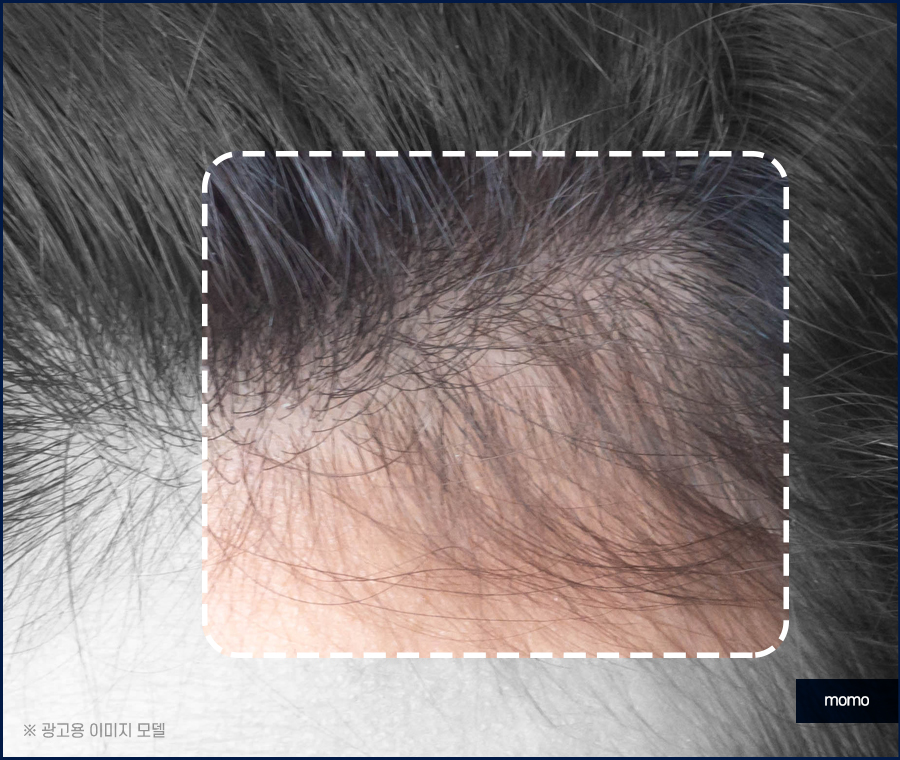 여성 모발이식 자연스러운 변화를 만드는 관련 이미지 10
