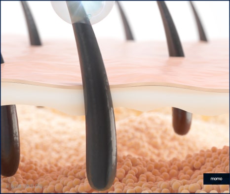 두피 종기 원인 및 치료, 관리 방법 관련 이미지 4