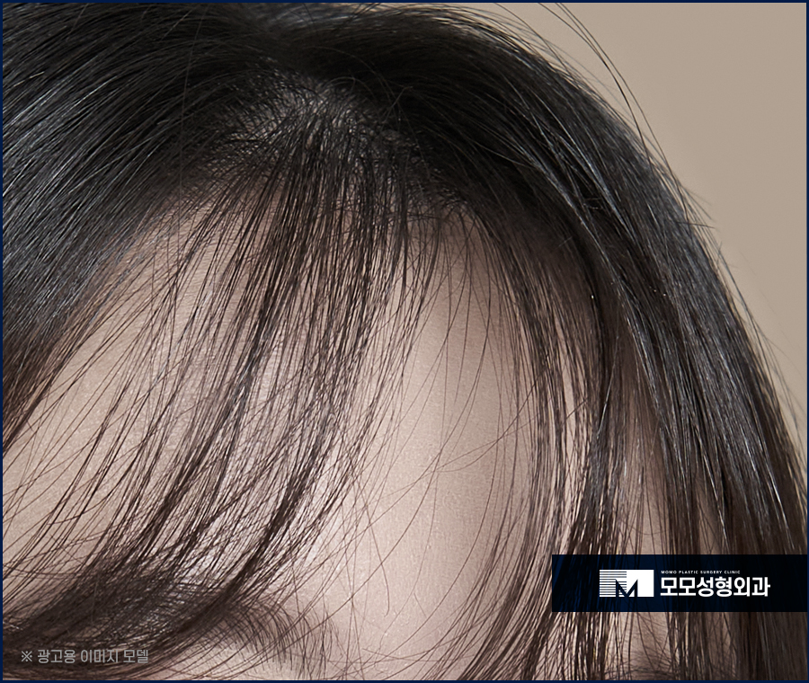 앞머리갈라짐 탈모 해결 방법까지 알아 보는 관련 이미지 9