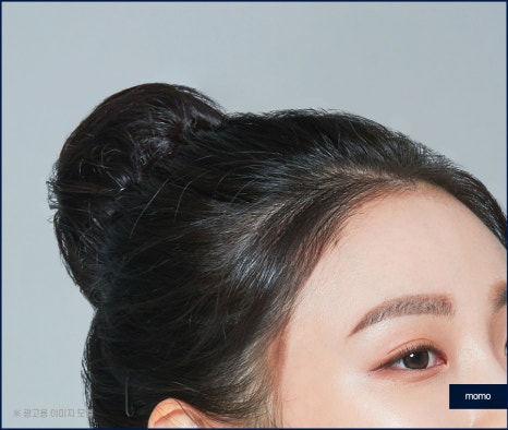 여자 m자 이마 헤어라인 모발이식으로 교정 관련 이미지 6