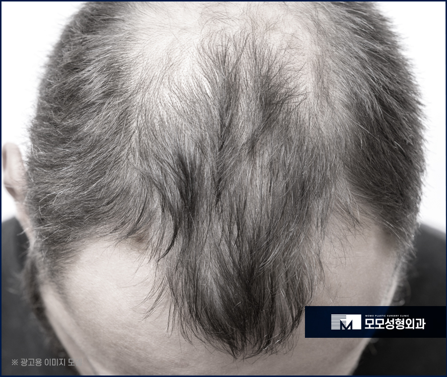 m자탈모모발이식 이미지 개선을 위한 선택 관련 이미지 3