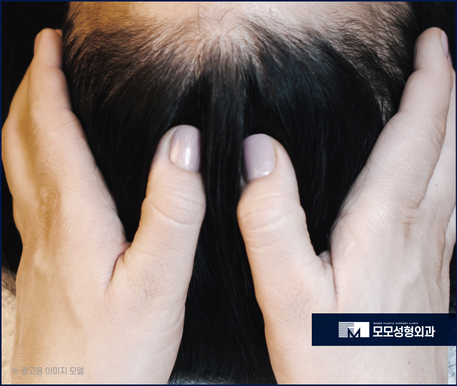 모발 얇아짐 심각성을 알고 경각심을 가져야만 관련 이미지 10