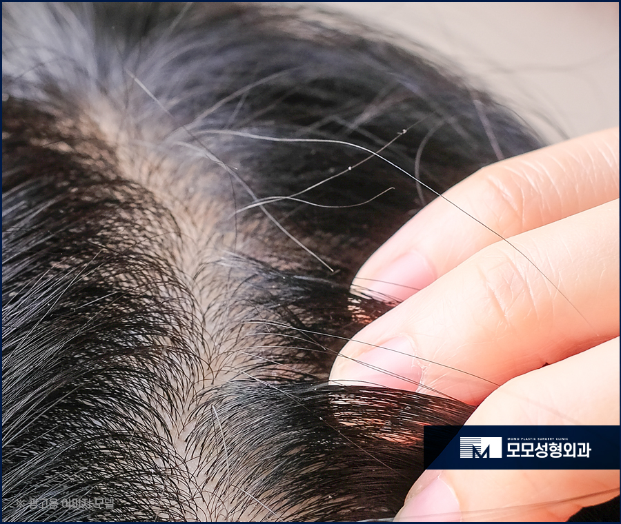 흰머리나는시기와 이유에 대해서 알아봅니다 관련 이미지 2