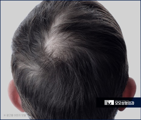 남자머리심기 신속한 일상 회복을 위한 방법 (ft. 비절개모발이식) 관련 이미지 8