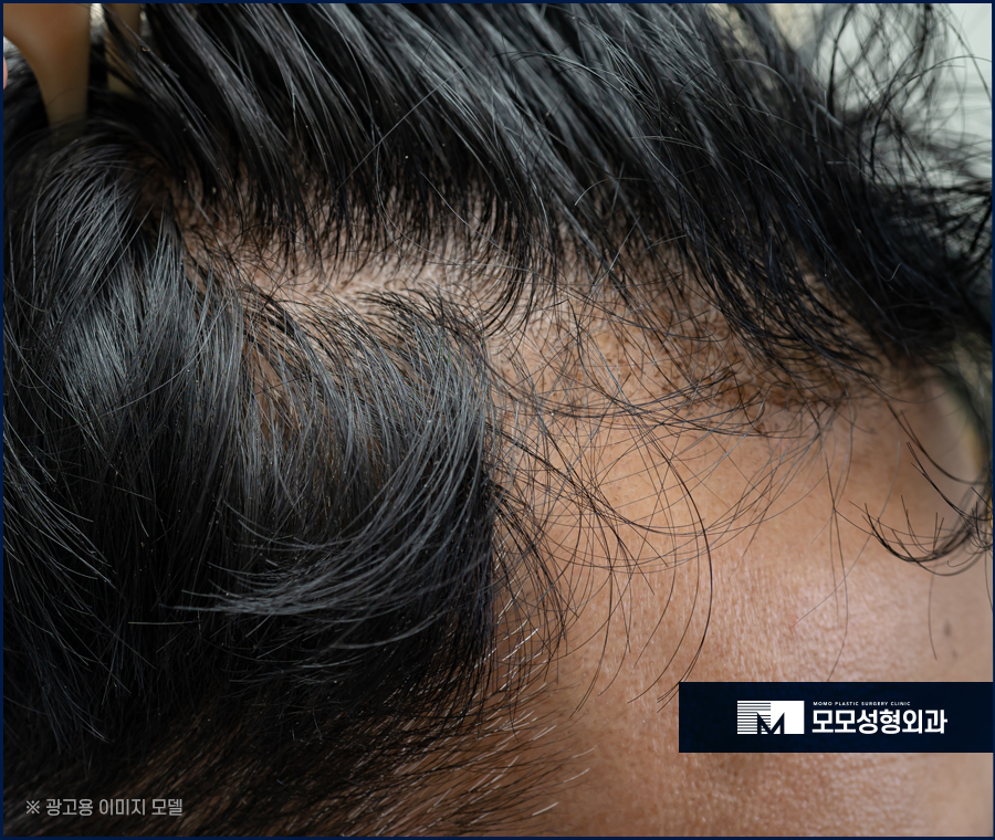 헤어라인 교정 비용 바라던 예후를 만들기 위한 관련 이미지 3