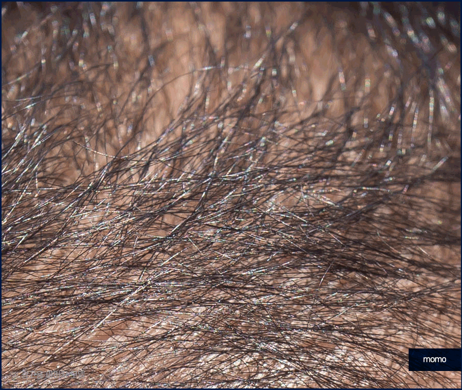 전두탈모 원인 보강을 위한 현명한 선택은? 관련 이미지 3