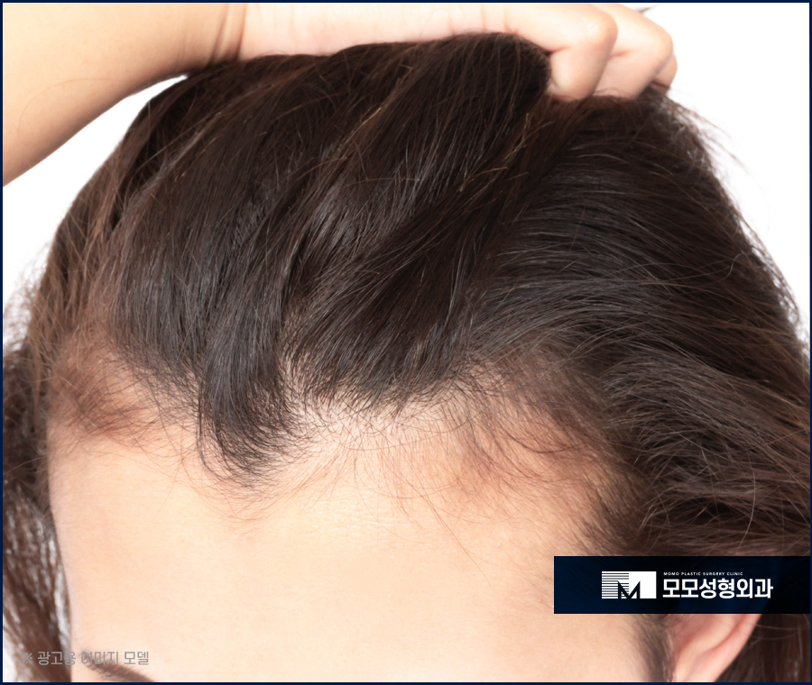여성 헤어라인 모발이식 미모까지 완벽해 지는 효과 관련 이미지 4