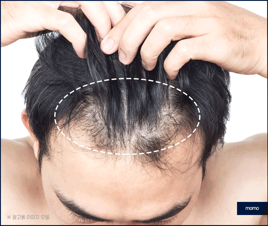 m자탈모병원 모발이식 고민이신 분들이라면 필독 관련 이미지 12