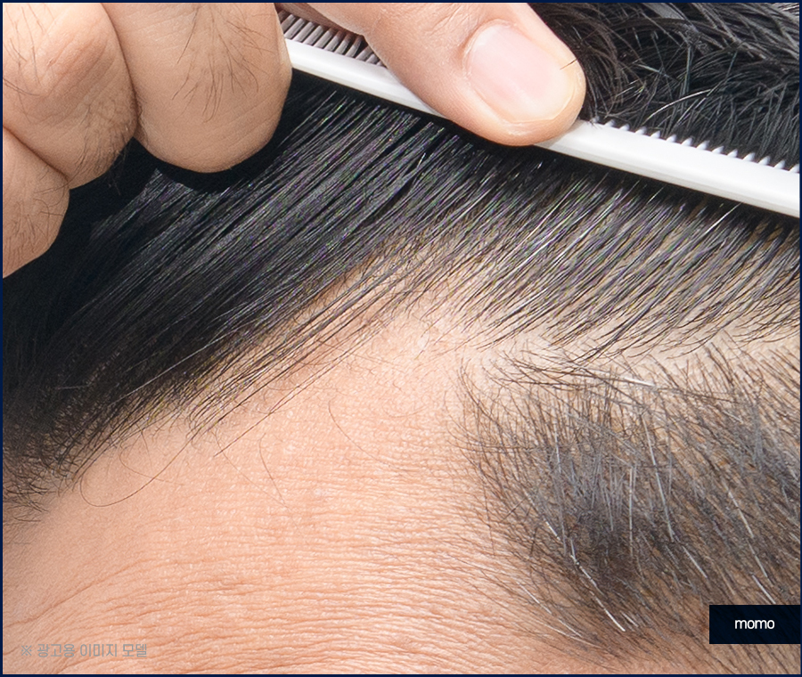 대량 모발이식 확연한 변화를 위해서 관련 이미지 5