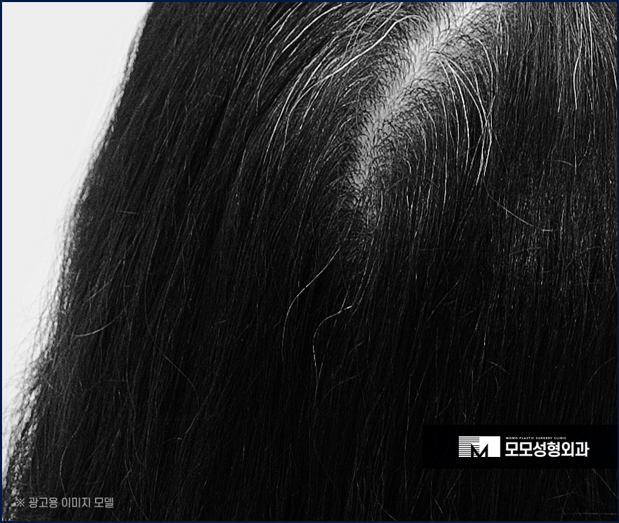 여자 옆머리 탈모 이유와 극복하고 채워가려면 관련 이미지 9