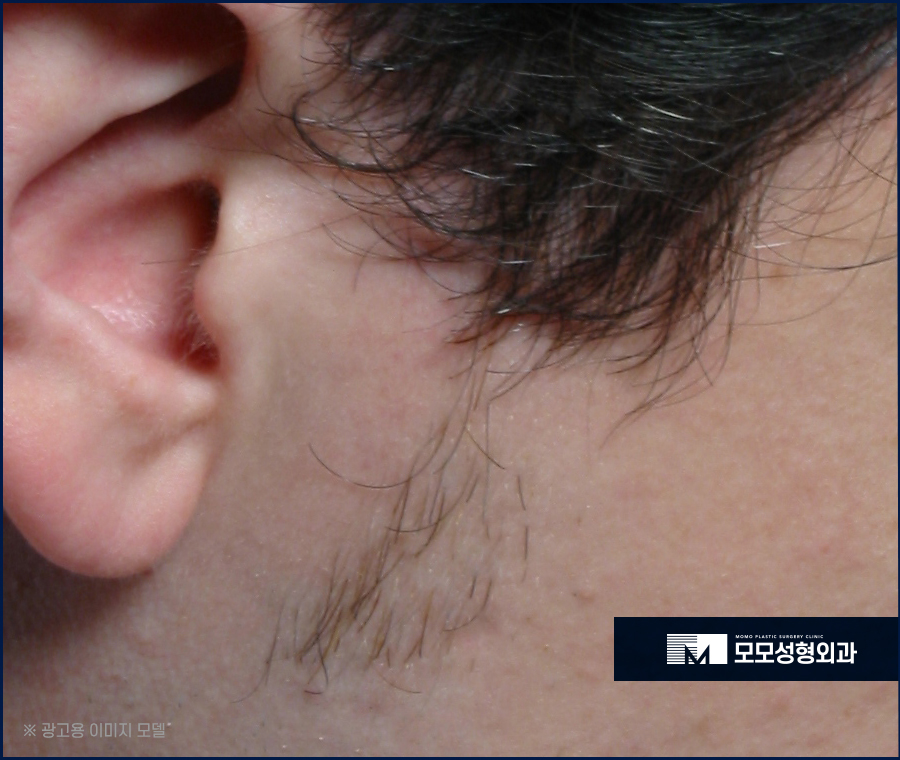 남자 옆머리 탈모 구레나룻의 양이 부족하다고 느껴질 경우엔 관련 이미지 4