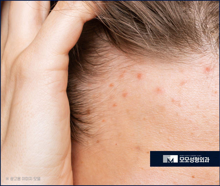 두피가려운이유 원인에 대해서 알아보는 관련 이미지 3