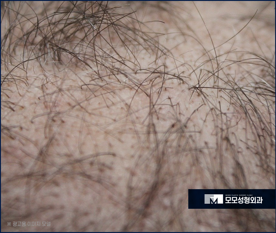 모발이식 주의사항과 꼼꼼히 숙지해야 하는 이유 관련 이미지 5