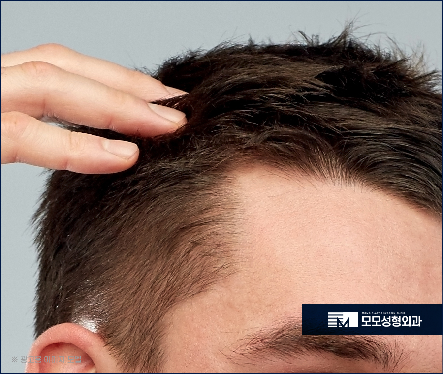 남자헤어라인교정 반듯함으로 완성하는 외모 관련 이미지 3