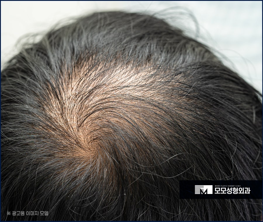 머리안감으면탈모 증상이 찾아올까요 진실은 관련 이미지 2