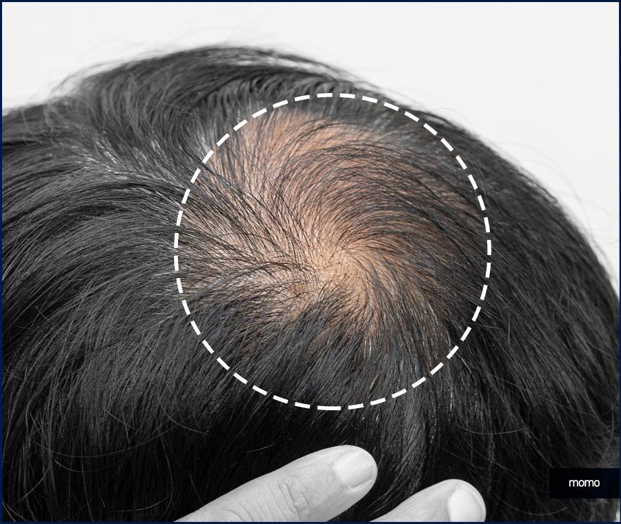모발이식3000모비용 차이나는 이유 관련 이미지 6