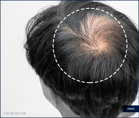 무삭발 모발이식 빠르게 회복하려면 관련 이미지 4