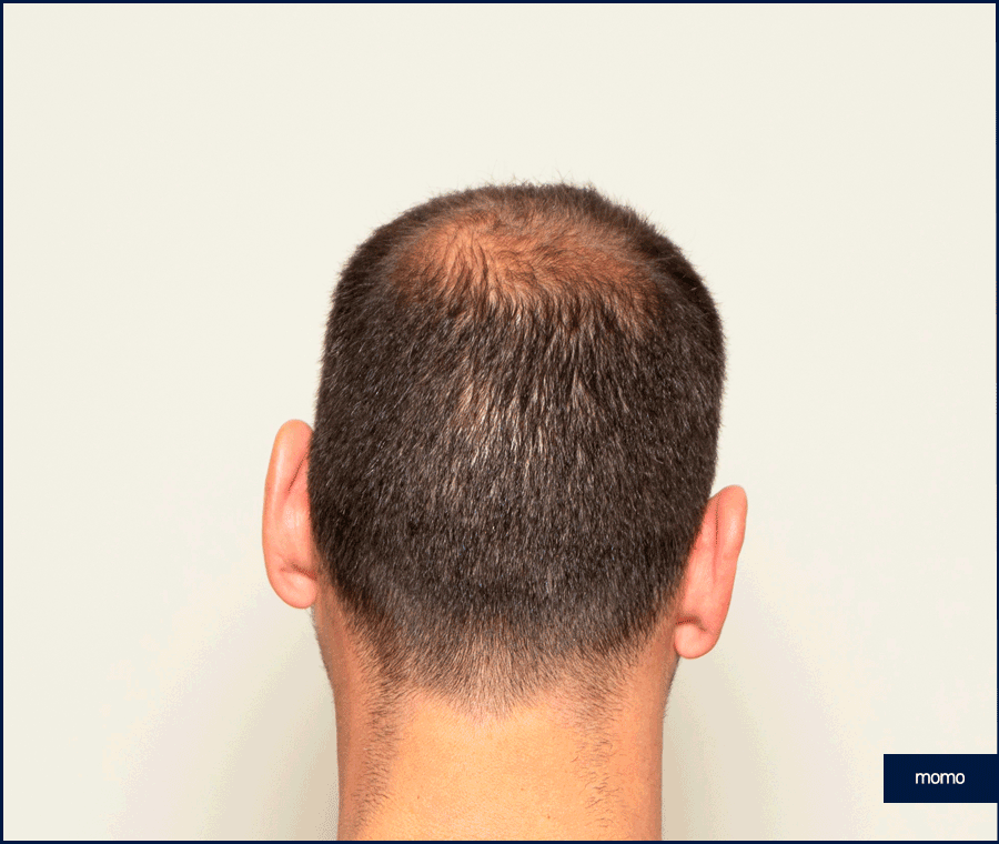 20대 모발이식 성공적인 결과를 위한 필수 조건 관련 이미지 8