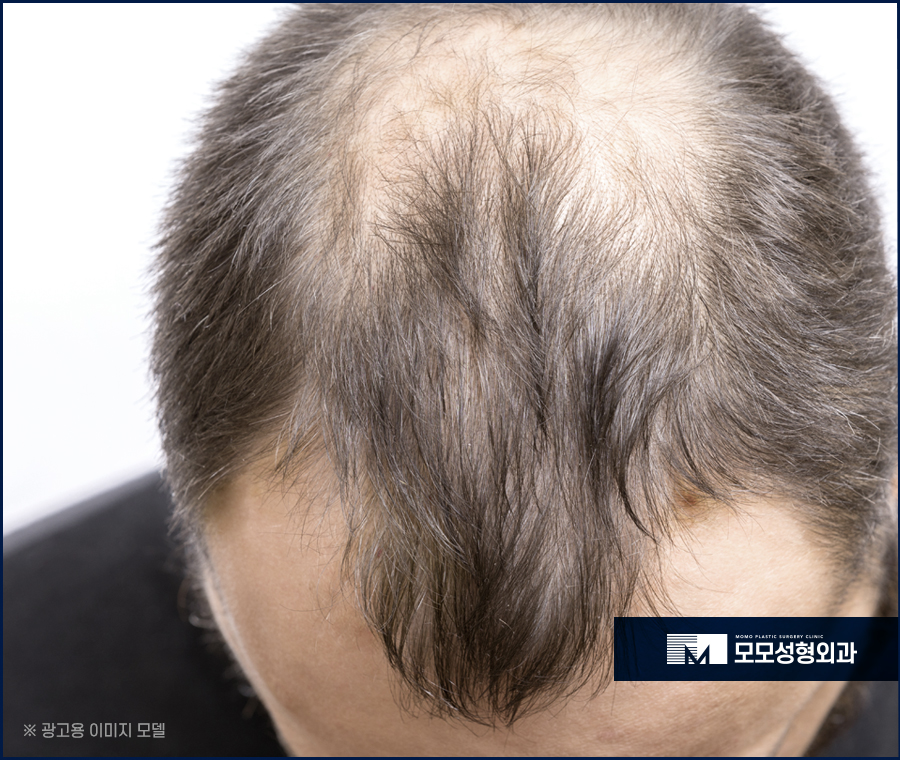 M자이마모발이식 빈 곳을 섬세하게 보완하며 관련 이미지 3