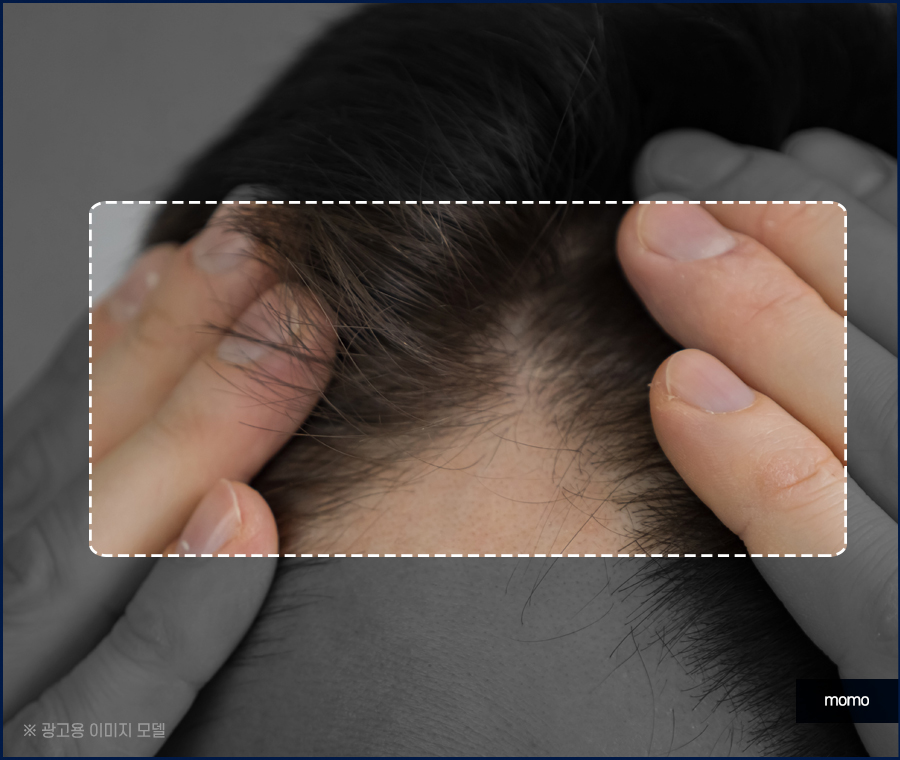 압구정탈모병원 절개가 부담스러울 경우 대안까지 관련 이미지 3