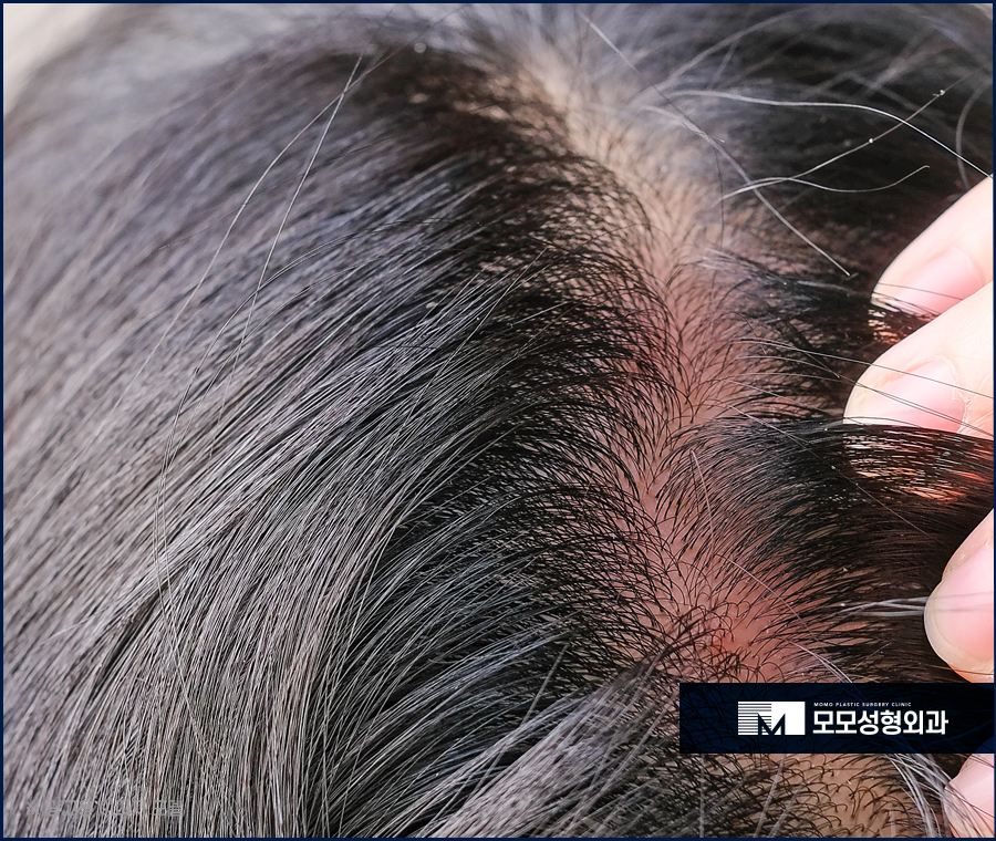 모발이식땀 나는 일은 생착률에 어떤 영향을 미칠까 관련 이미지 6