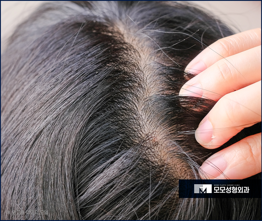 남자가르마탈모 훤하게 보이고 있다면 관련 이미지 2