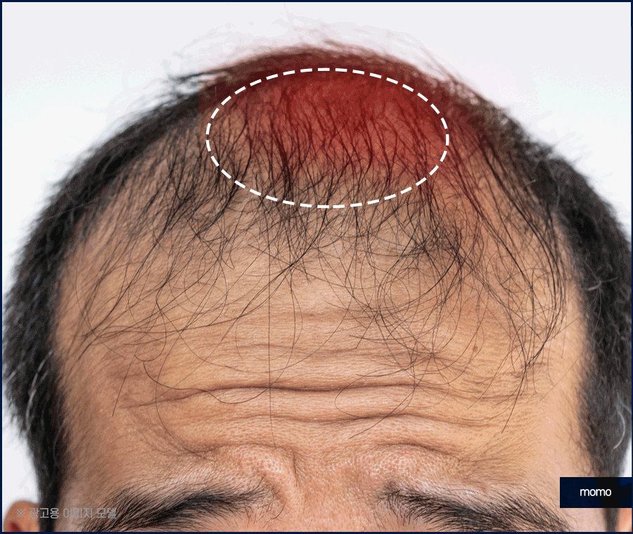 남자 탈모약으로 치료할 때 확인할 사항 관련 이미지 3