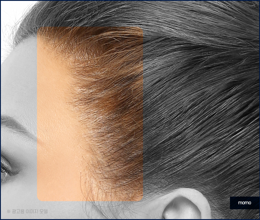 여자 M자 탈모 자연스럽게 채워가는 관련 이미지 4