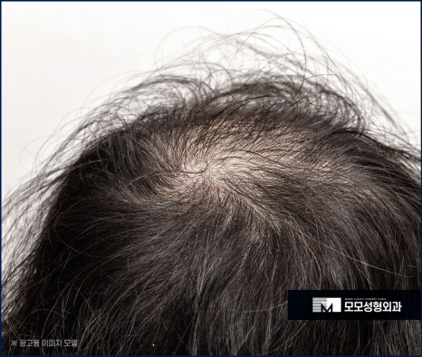 남자머리심기 신속한 일상 회복을 위한 방법 (ft. 비절개모발이식) 관련 이미지 7