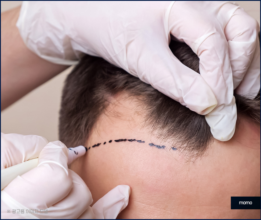 m자탈모초기 빠른 대처를 이뤄낸다면 관련 이미지 11