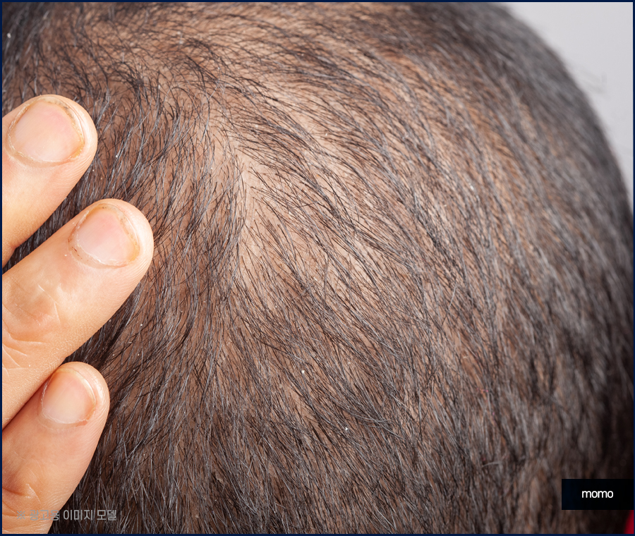 강남 모발이식 정교하게 보완하는 관련 이미지 7