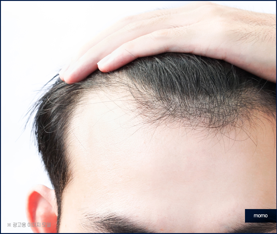 엠자이마 고민 탈출을 위한 모발이식 관련 이미지 7