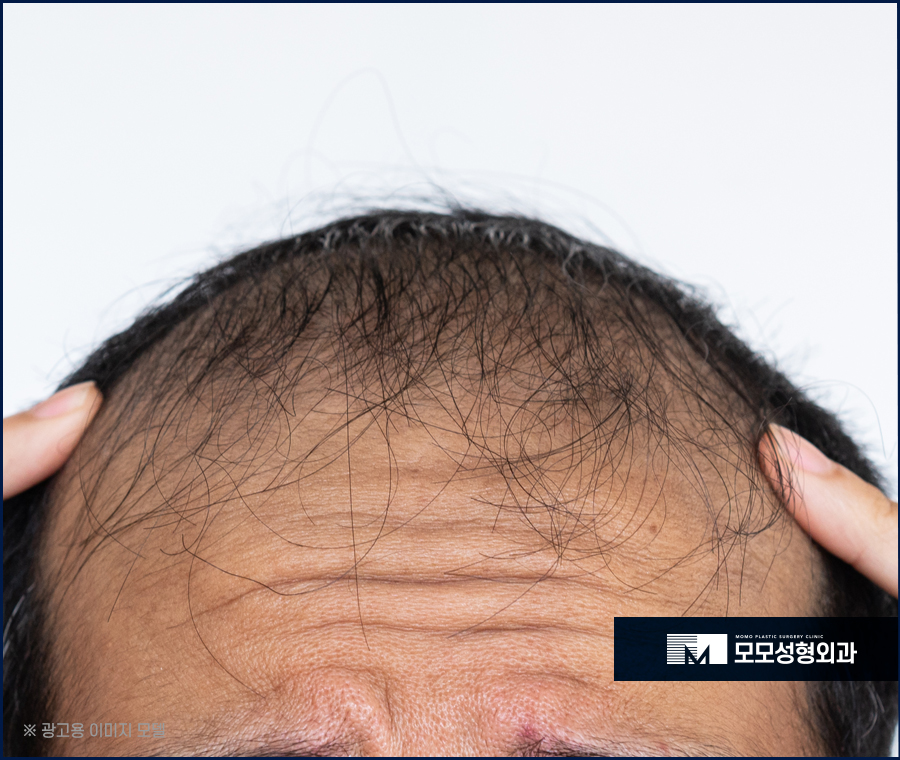 강남탈모병원 진단부터 섬세한 곳에서 해야만 관련 이미지 5