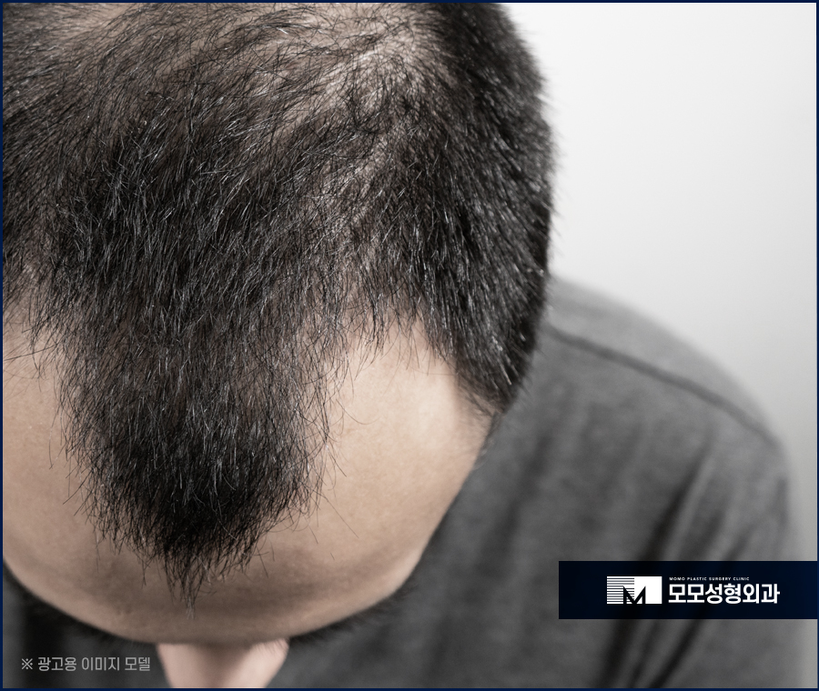 모발이식 주의사항과 꼼꼼히 숙지해야 하는 이유 관련 이미지 2