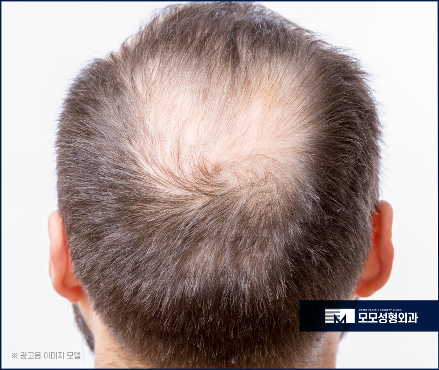 압구정탈모병원 체계적인 진단으로 관련 이미지 3