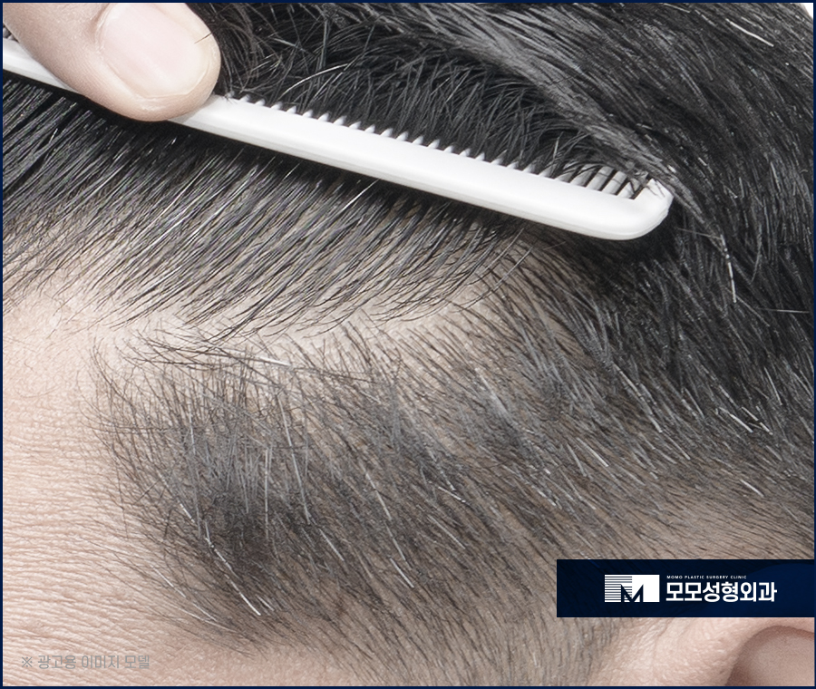 체모 이식 부위별 특성 고려해서 자연스런 결과로 관련 이미지 3