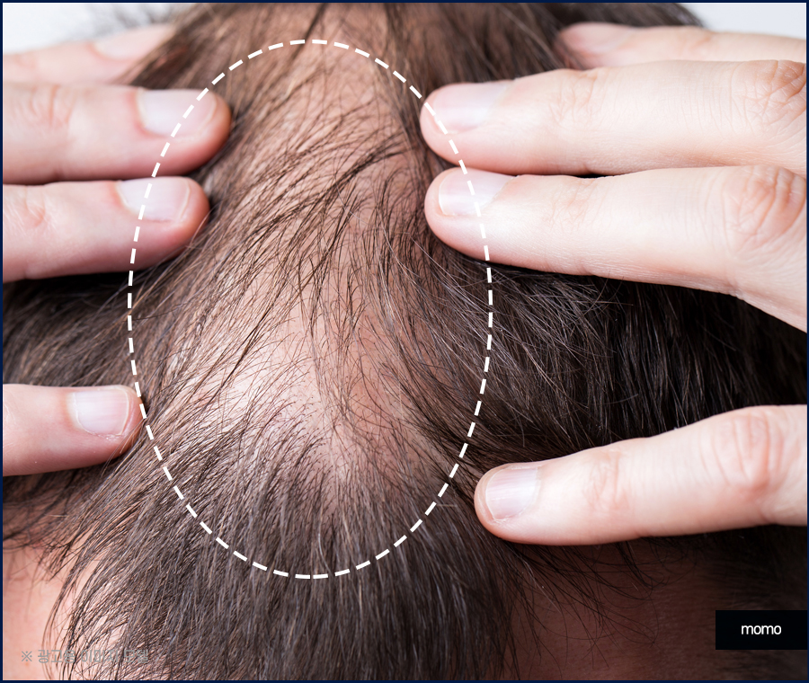 강남 모발이식 정교하게 보완하는 관련 이미지 5