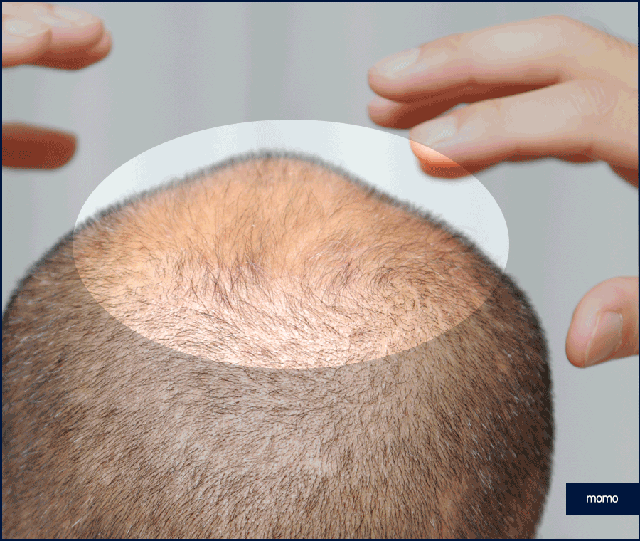 전두탈모 원인 보강을 위한 현명한 선택은? 관련 이미지 6