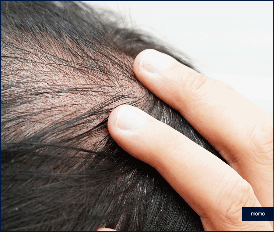 탈모약 복용시간의 중요성 및 주의사항 정리 관련 이미지 3