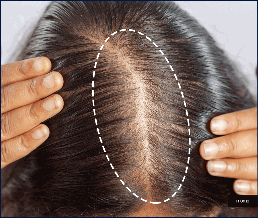 중학생탈모 발생 원인 및 보완하는 방법은? 관련 이미지 5