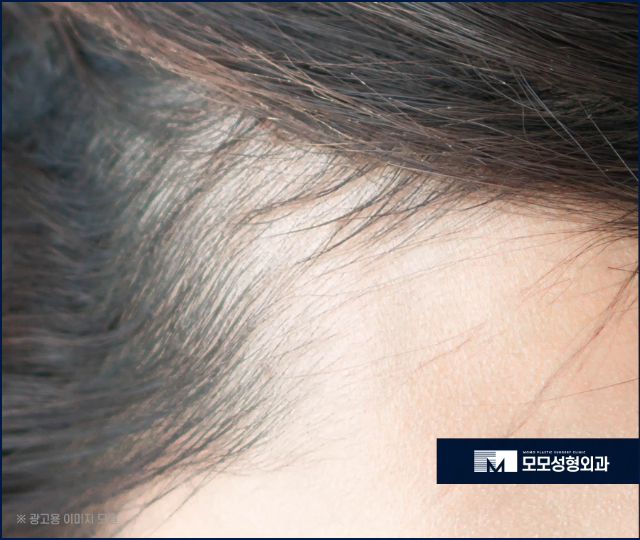 m자형 탈모 보완 시 꼭 짚어야 할 체크 포인트 (ft. 모발이식) 관련 이미지 10