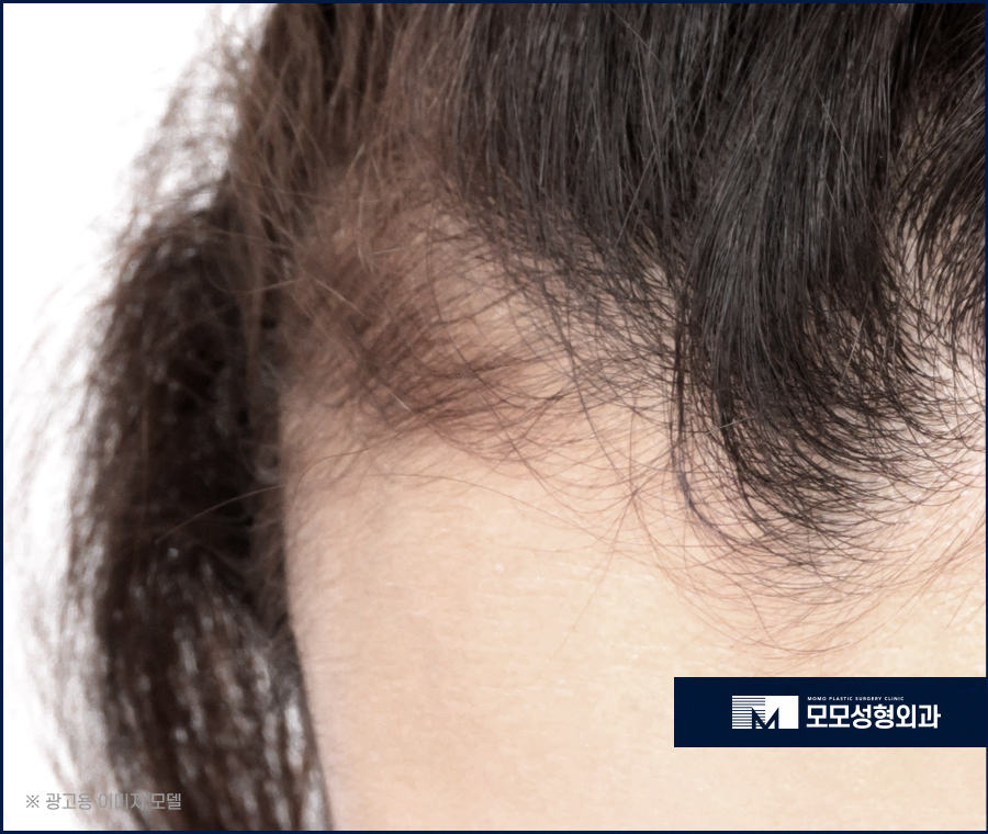 미녹시딜 5% 효과와 사용 전 알아두어야 할 점 관련 이미지 7