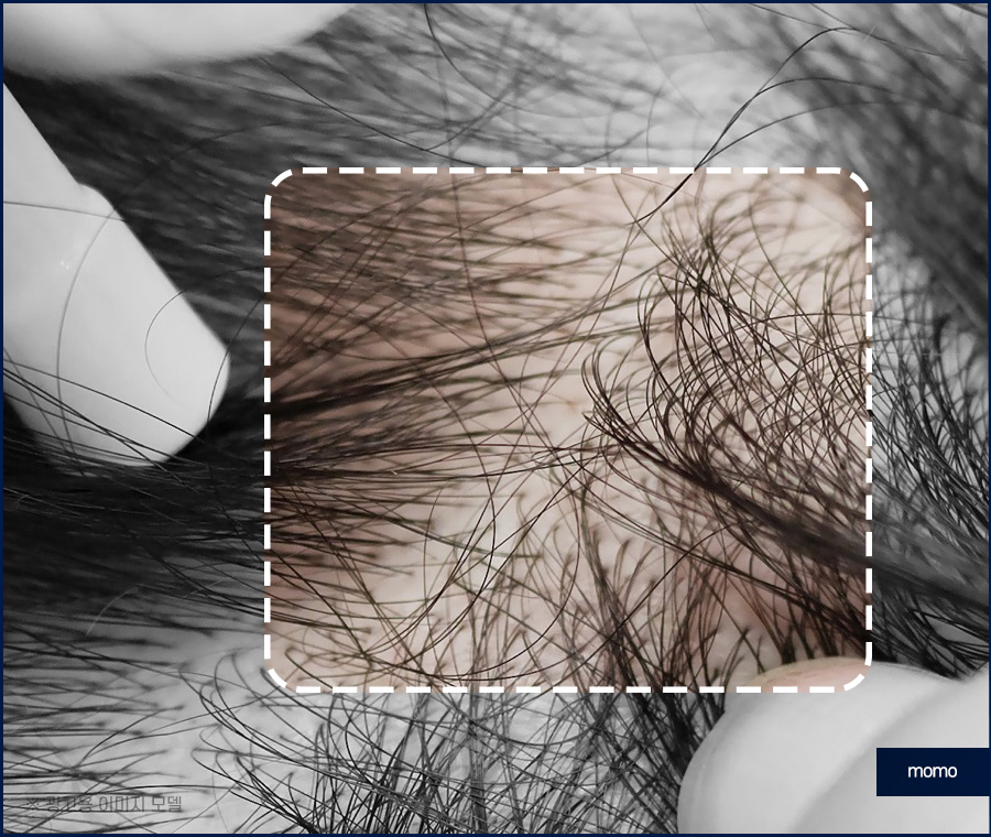 비절개 모발이식 비용 개인차를 고려해서 관련 이미지 5