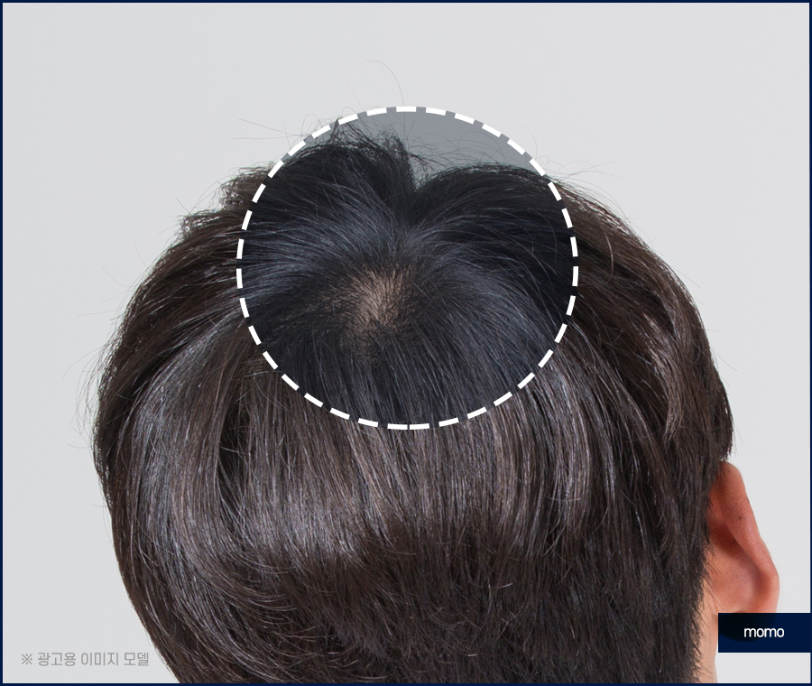 남자 가르마 탈모 진짜 내 머리처럼 채우려면 관련 이미지 6