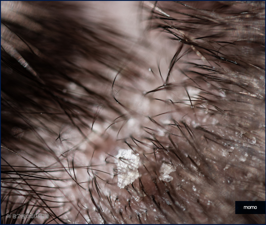 정수리 냄새 원인과 제거하기 위한 방법은 관련 이미지 5