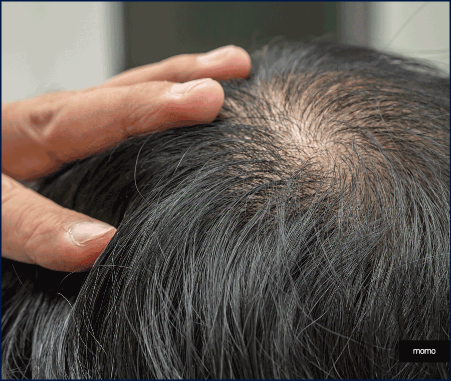 남자 모발이식 비용, 방법까지 꼼꼼히 확인하세요! 관련 이미지 11