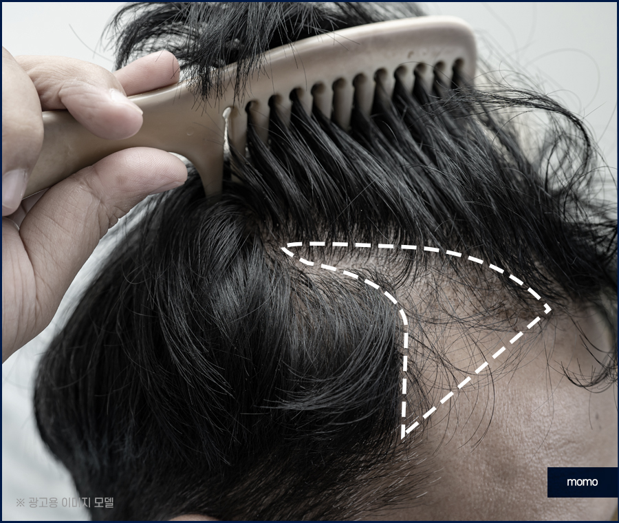 남자 헤어라인 교정 불규칙한 라인 보완을 위해 관련 이미지 9