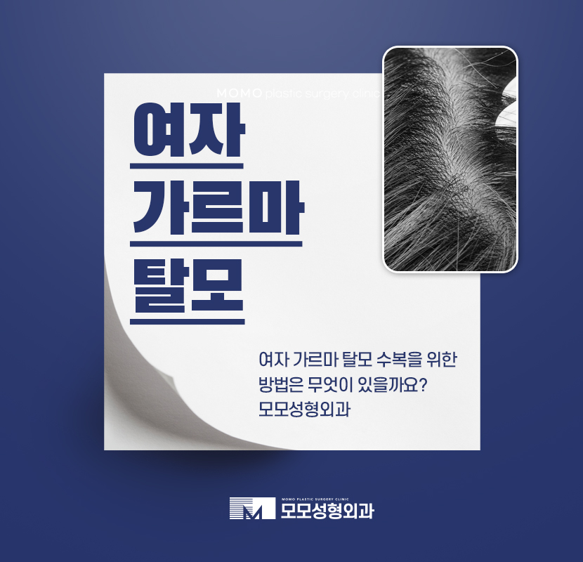 여자가르마탈모 수복을 위한 시술은 관련 이미지 1